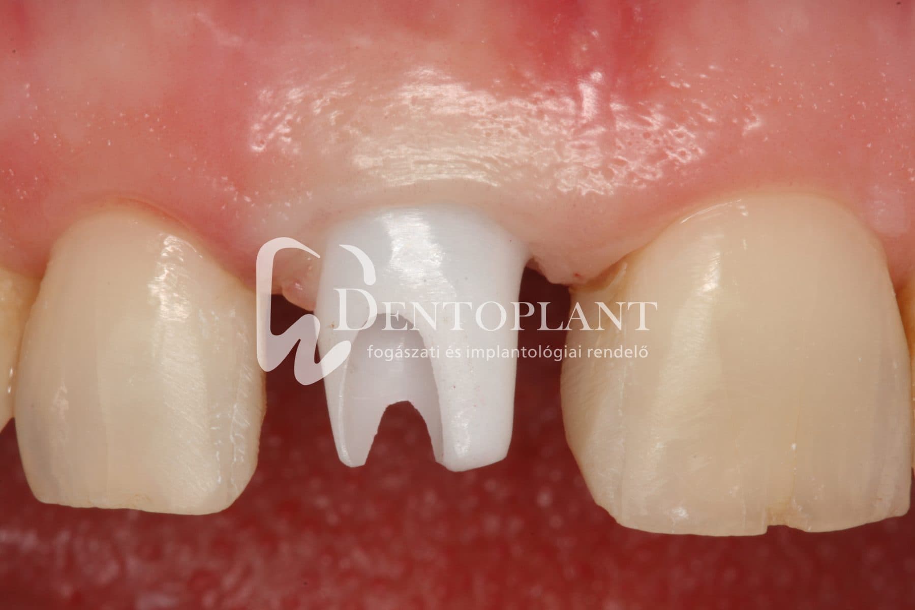 Esztétikai zónában azonnali implantáció előtte – utána – 9. kép