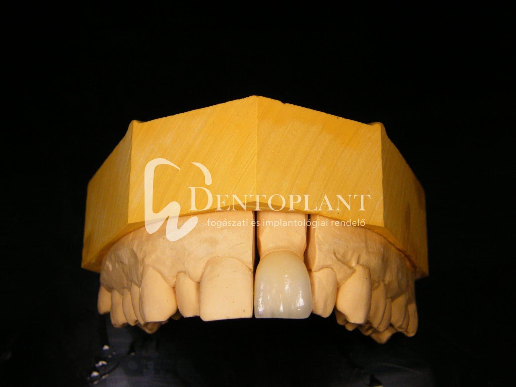 Kerámia korona felépített fogra – 5. kép