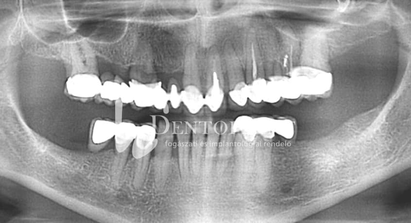 Kétoldali sorvégi foghiány pótlása implantátumokkal az alsó állcsonton – 1. kép