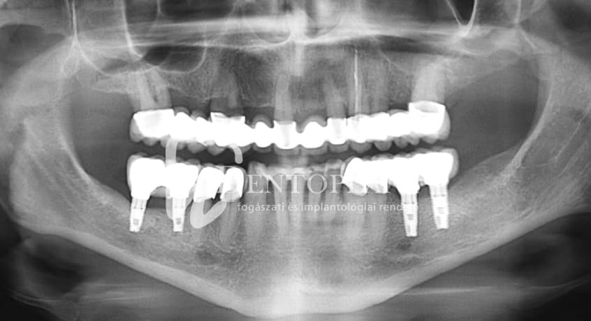 Kétoldali sorvégi foghiány pótlása implantátumokkal az alsó állcsonton – 2. kép