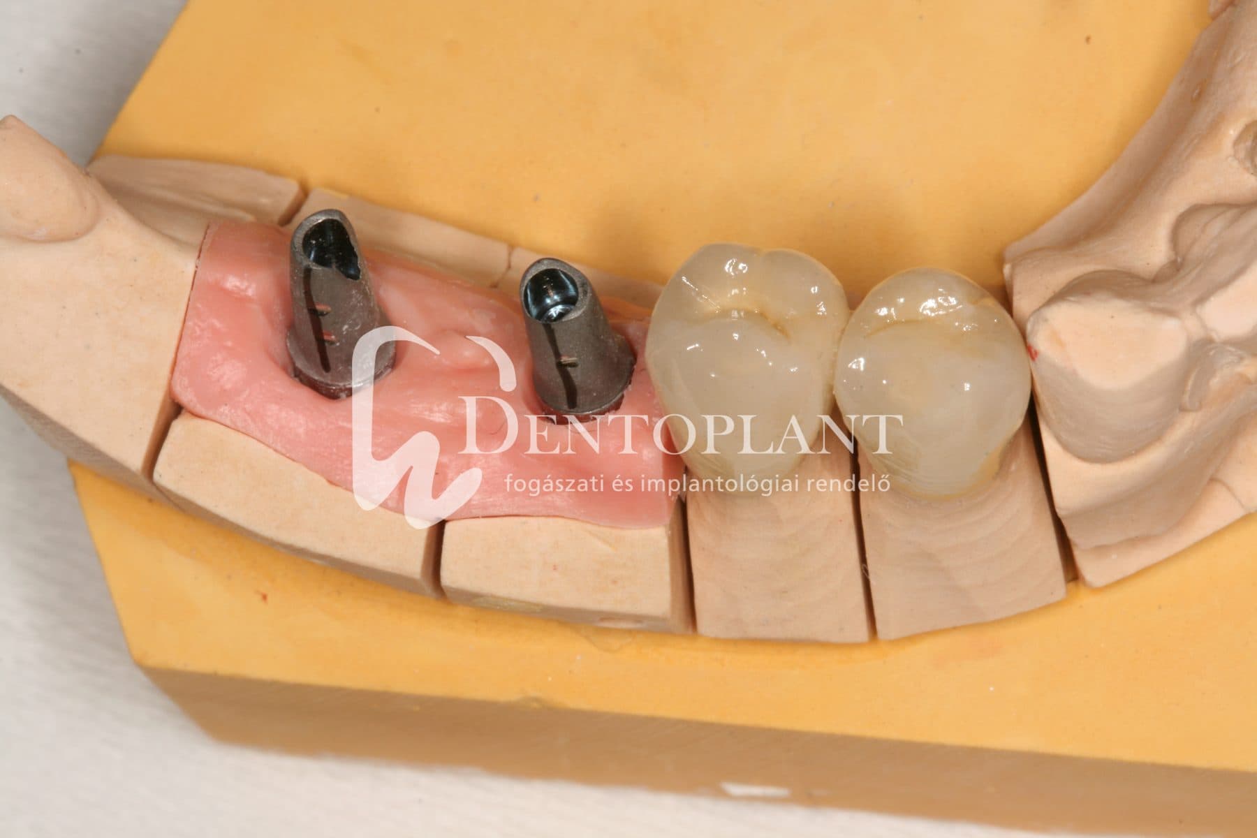 Kétoldali sorvégi foghiány pótlása implantátumokkal az alsó állcsonton – 3. kép