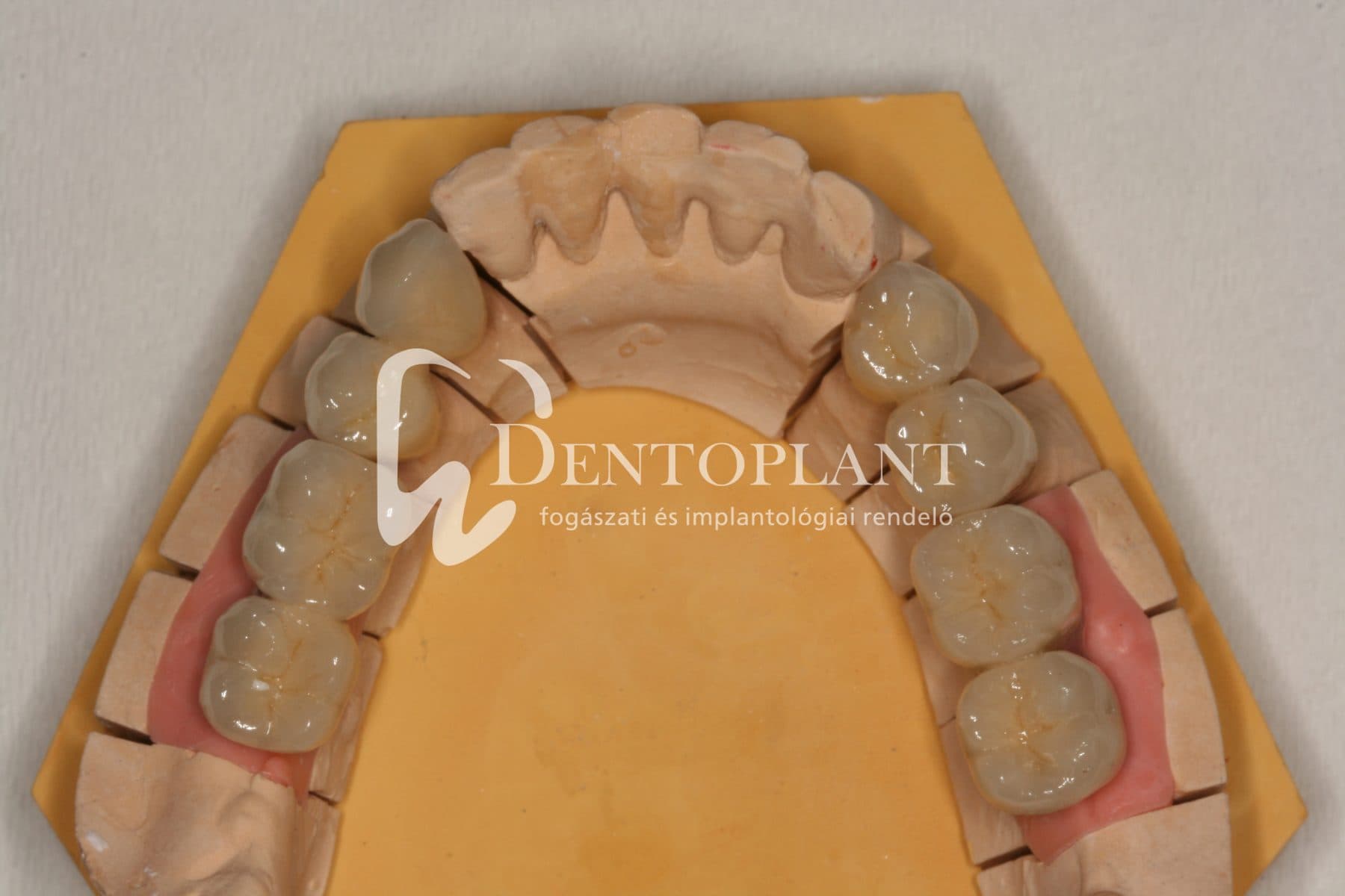 Kétoldali sorvégi foghiány pótlása implantátumokkal az alsó állcsonton – 4. kép