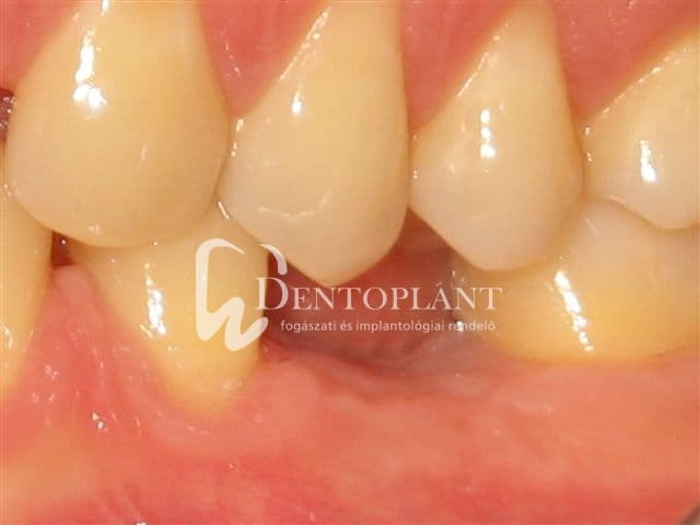 Moláris fog pótlása implantátummal – 1. kép (előtte)