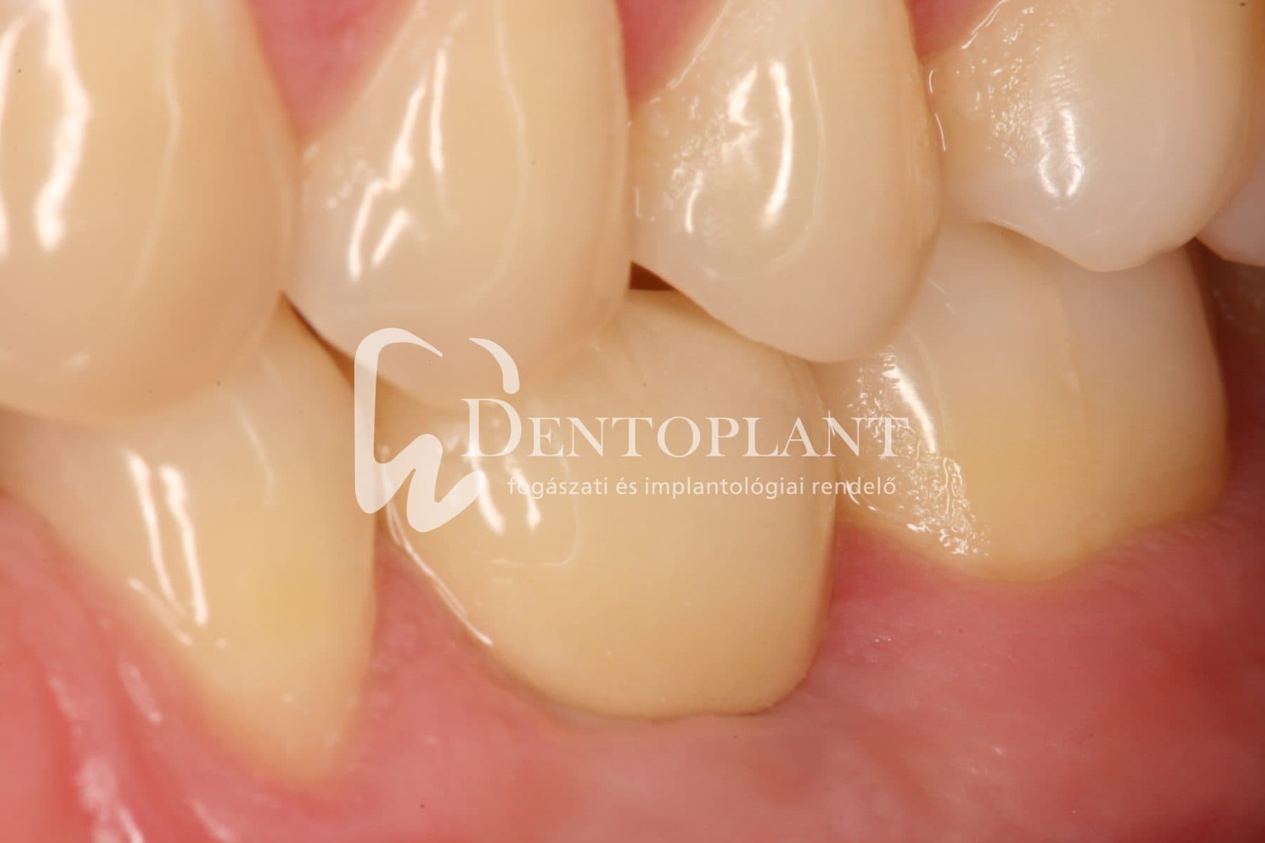 Moláris fog pótlása implantátummal – 2. kép (utána)
