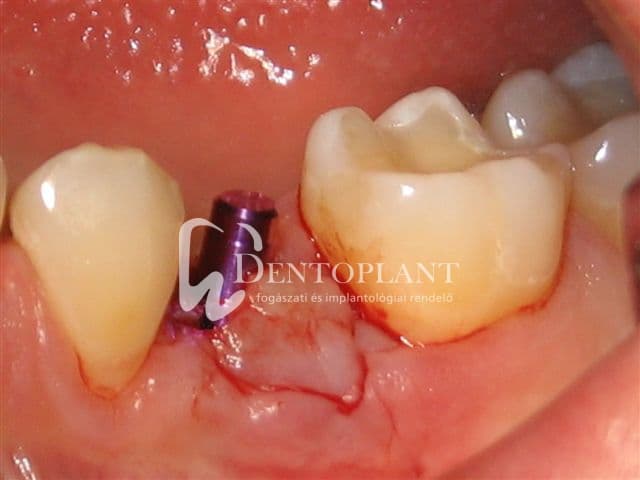 Moláris fog pótlása implantátummal – 3. kép