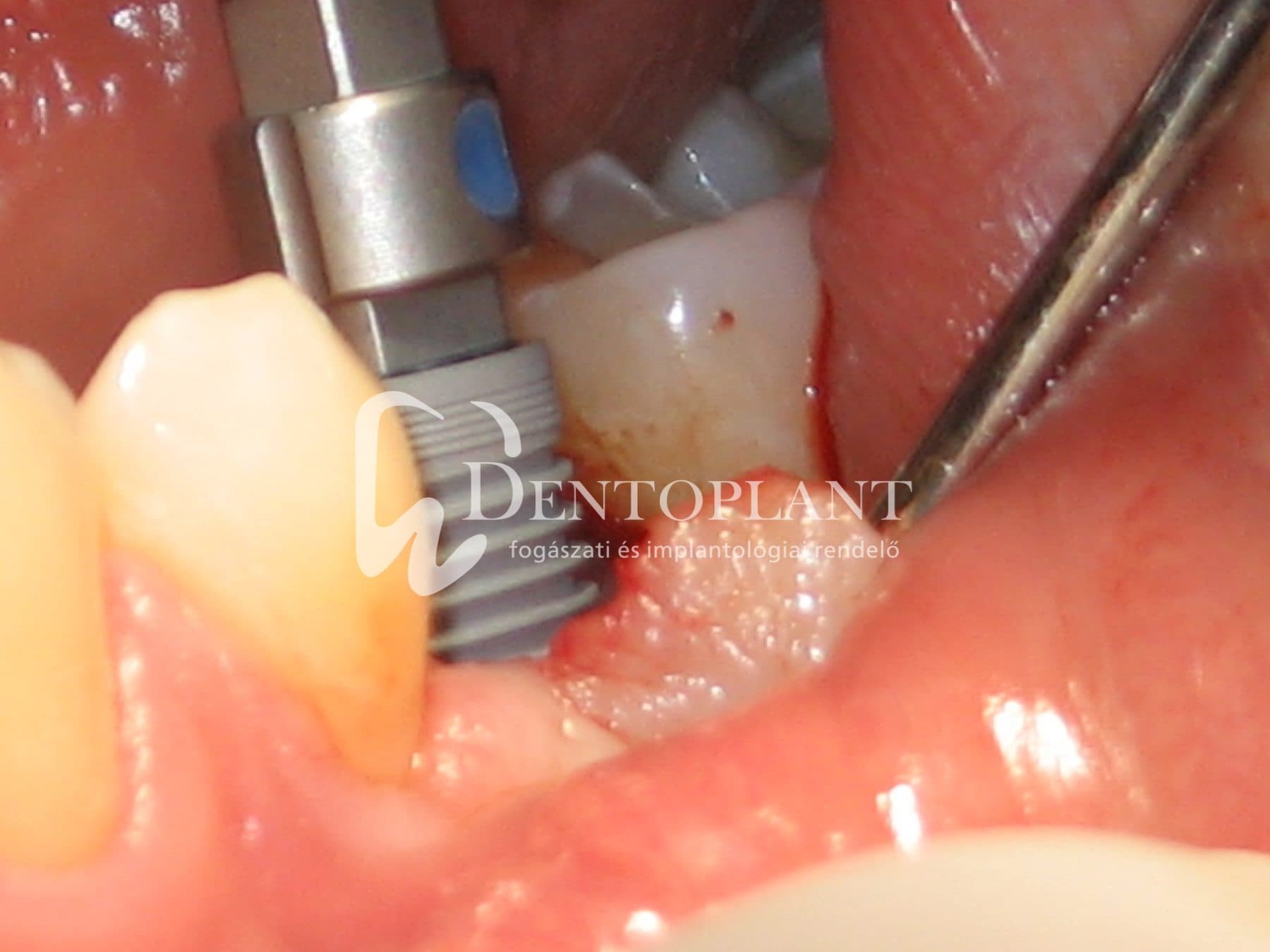 Moláris fog pótlása implantátummal – 4. kép