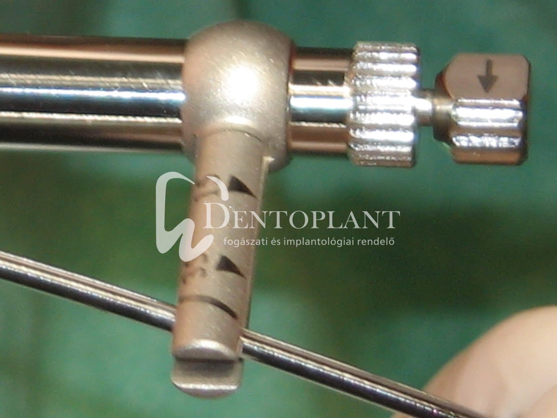 Moláris fog pótlása implantátummal – 5. kép