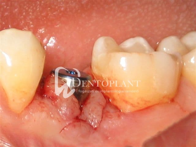 Moláris fog pótlása implantátummal – 6. kép
