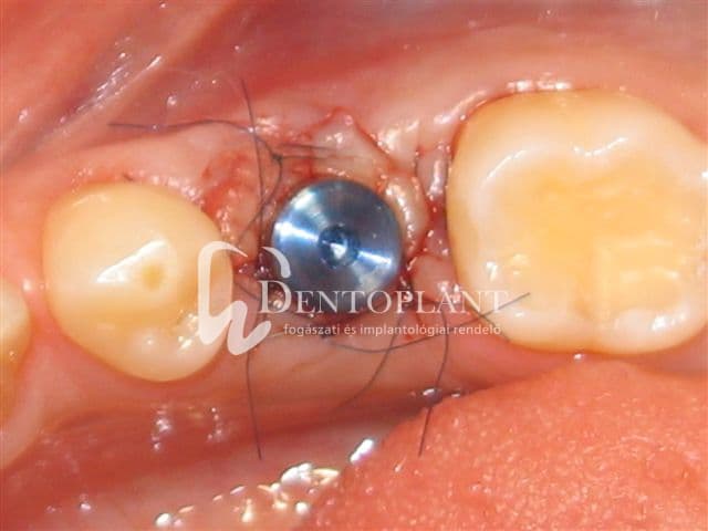 Moláris fog pótlása implantátummal – 7. kép