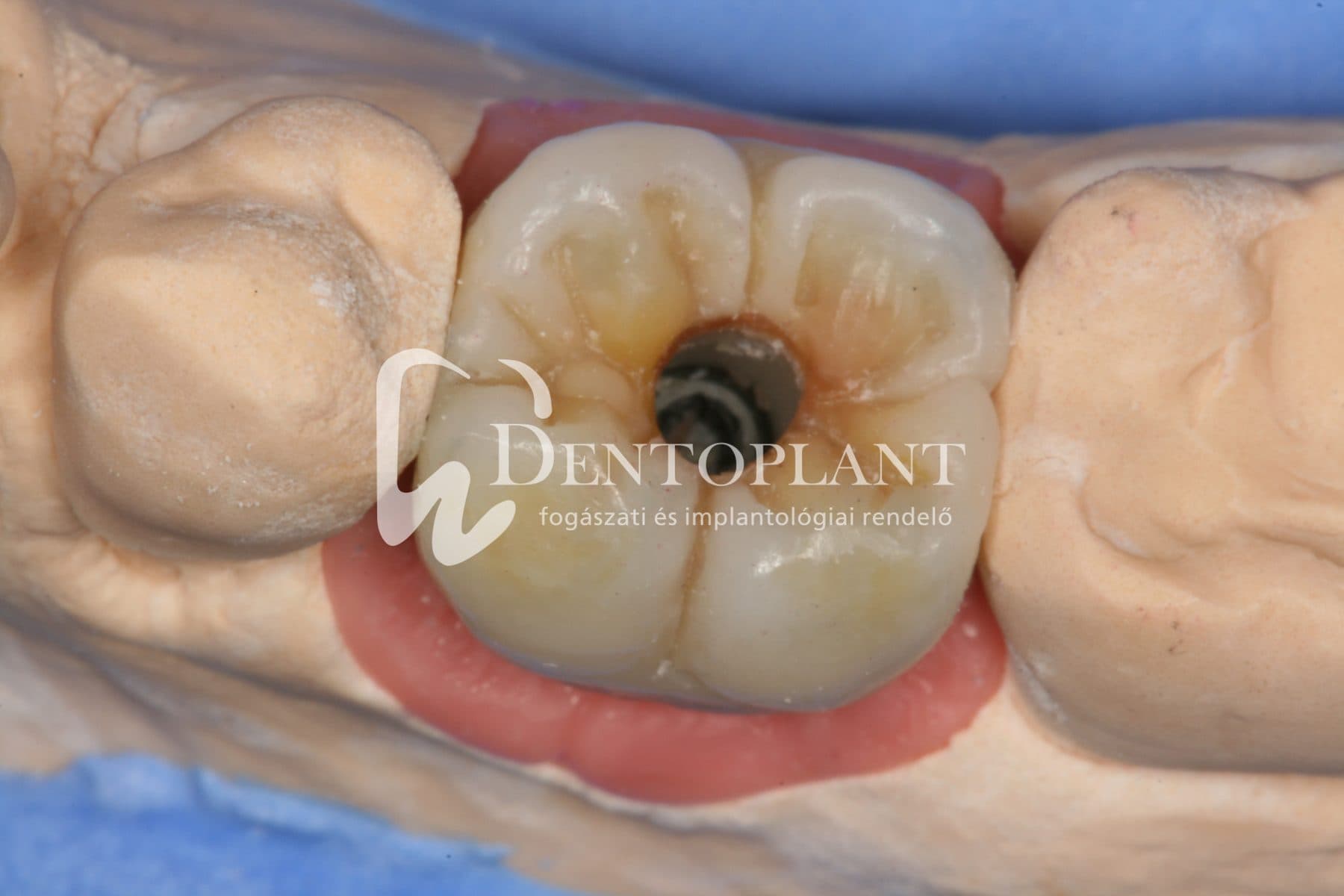 Moláris fog pótlása implantátummal – 8. kép