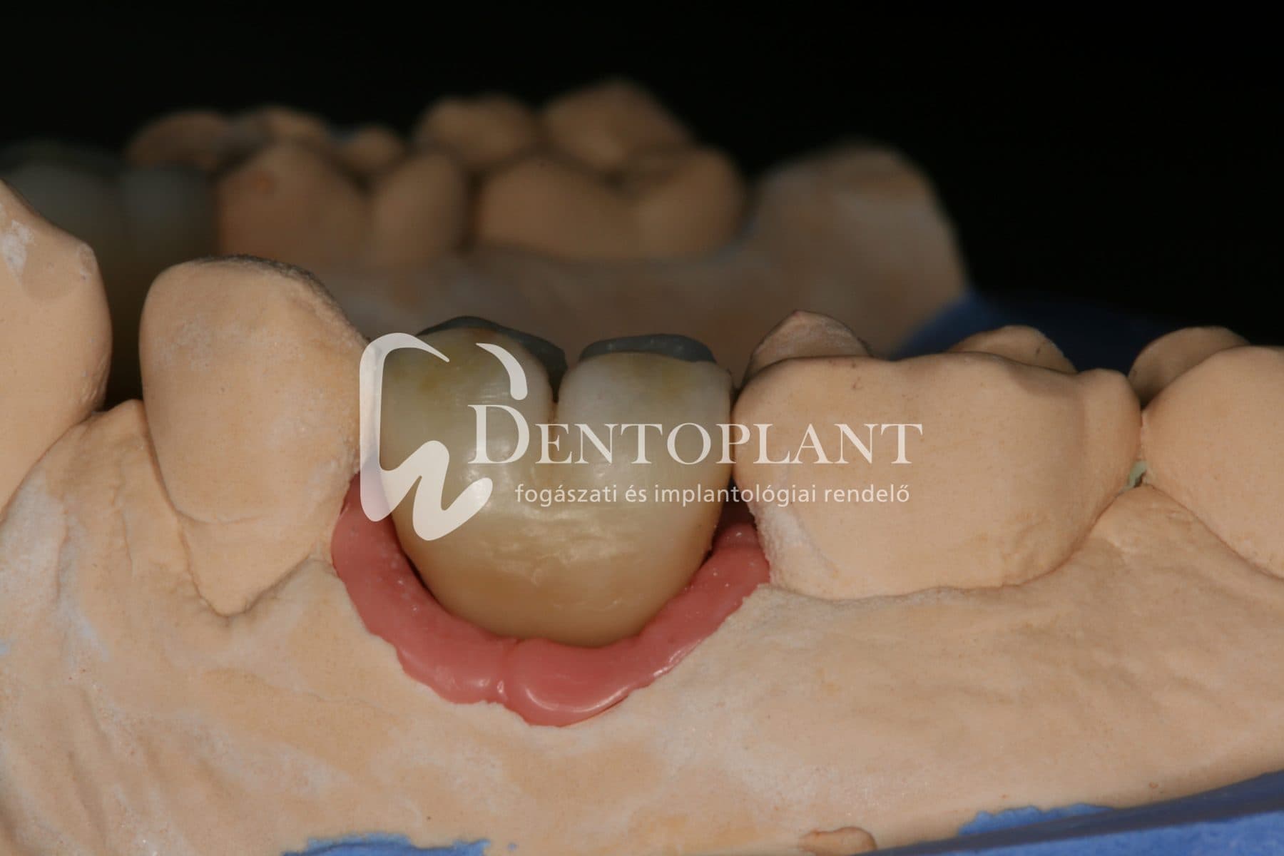 Moláris fog pótlása implantátummal – 9. kép