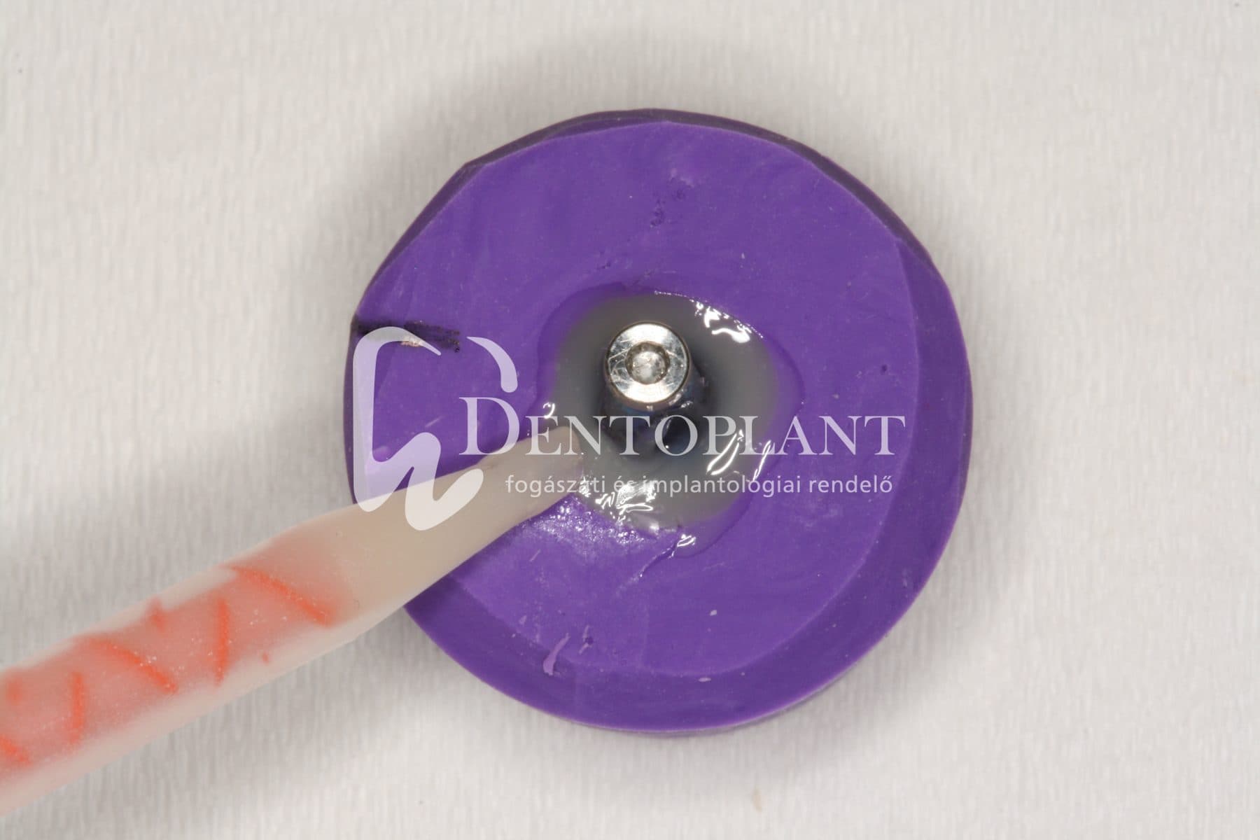 Moláris fog pótlása implantátummal – 10. kép