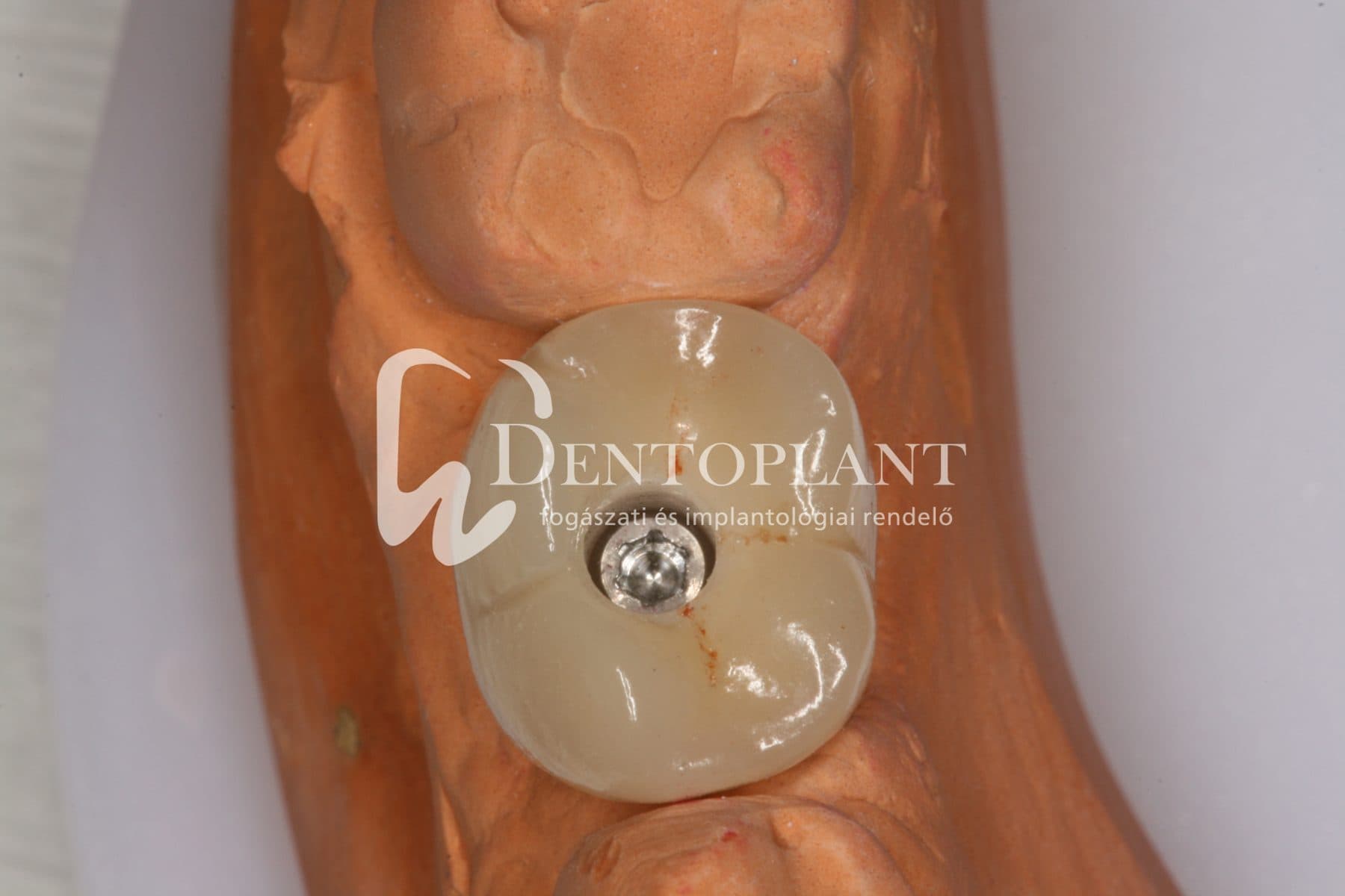 Moláris fog pótlása implantátummal – 11. kép