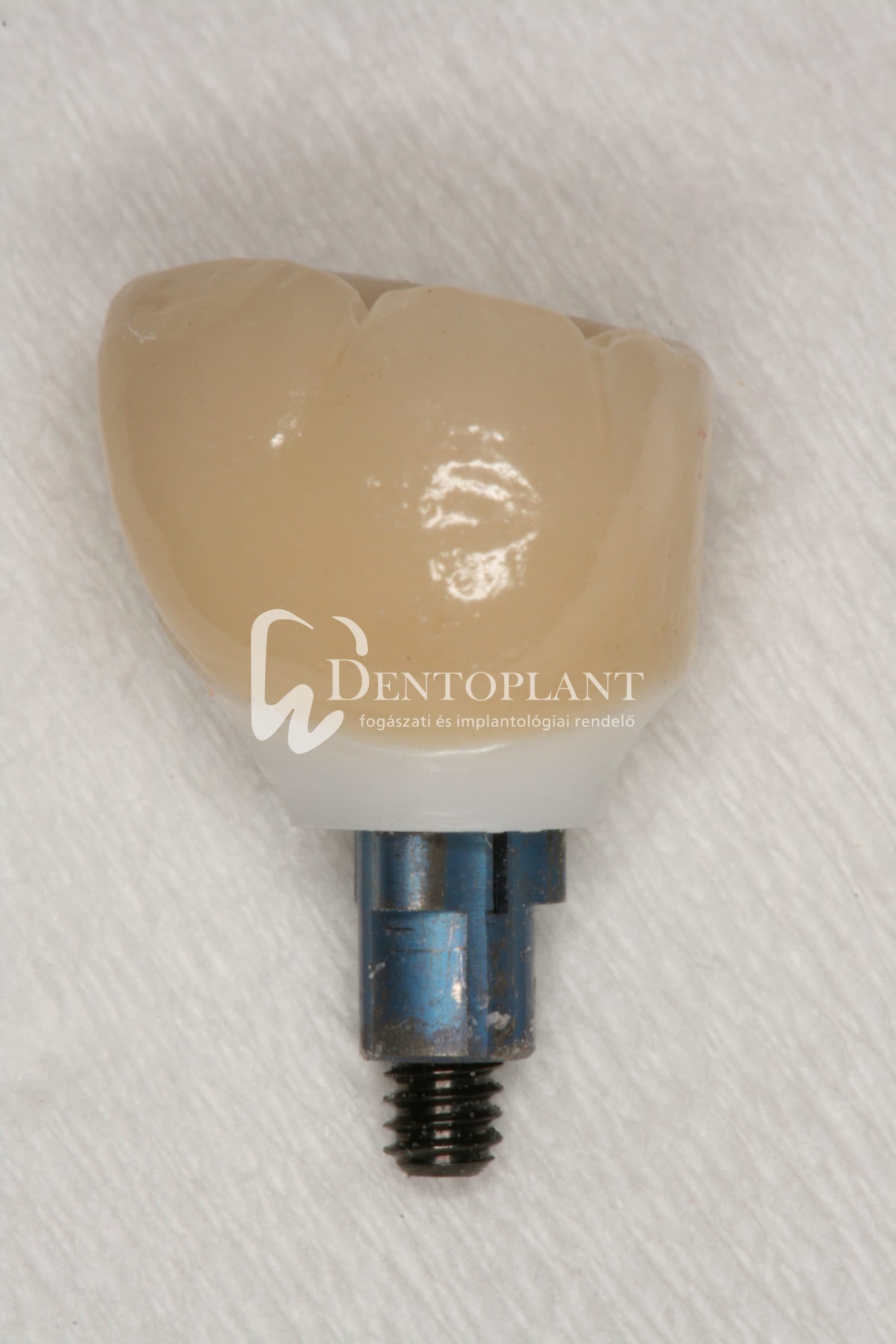 Moláris fog pótlása implantátummal – 12. kép