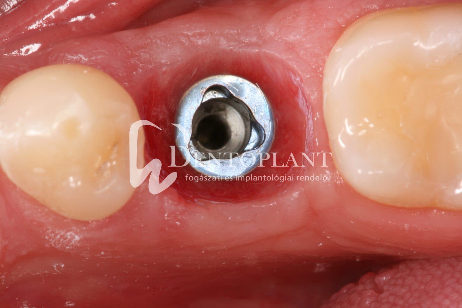 Moláris fog pótlása implantátummal – 13. kép