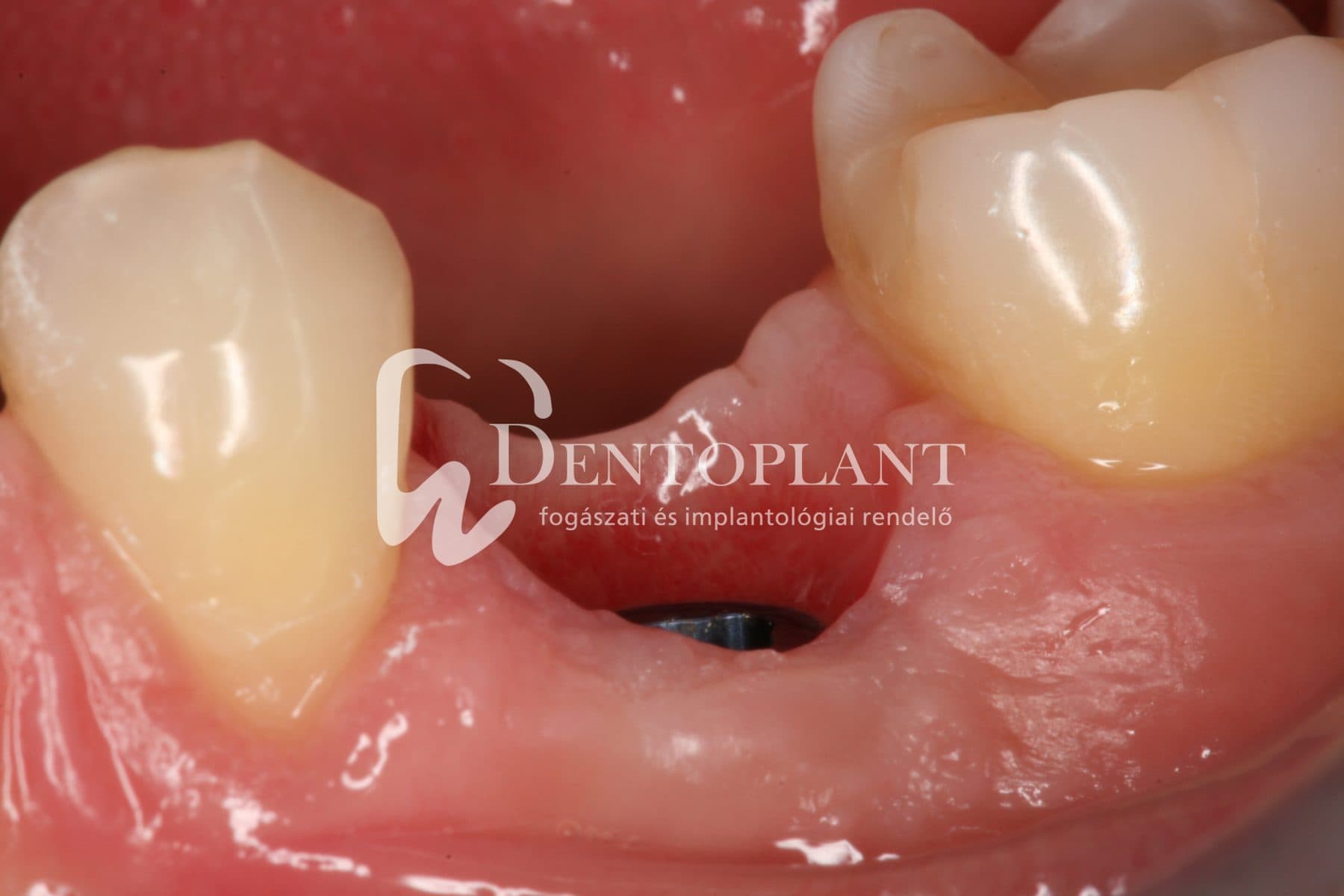 Moláris fog pótlása implantátummal – 14. kép