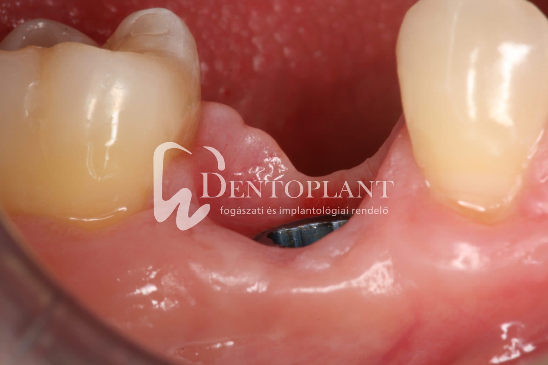 Moláris fog pótlása implantátummal – 15. kép