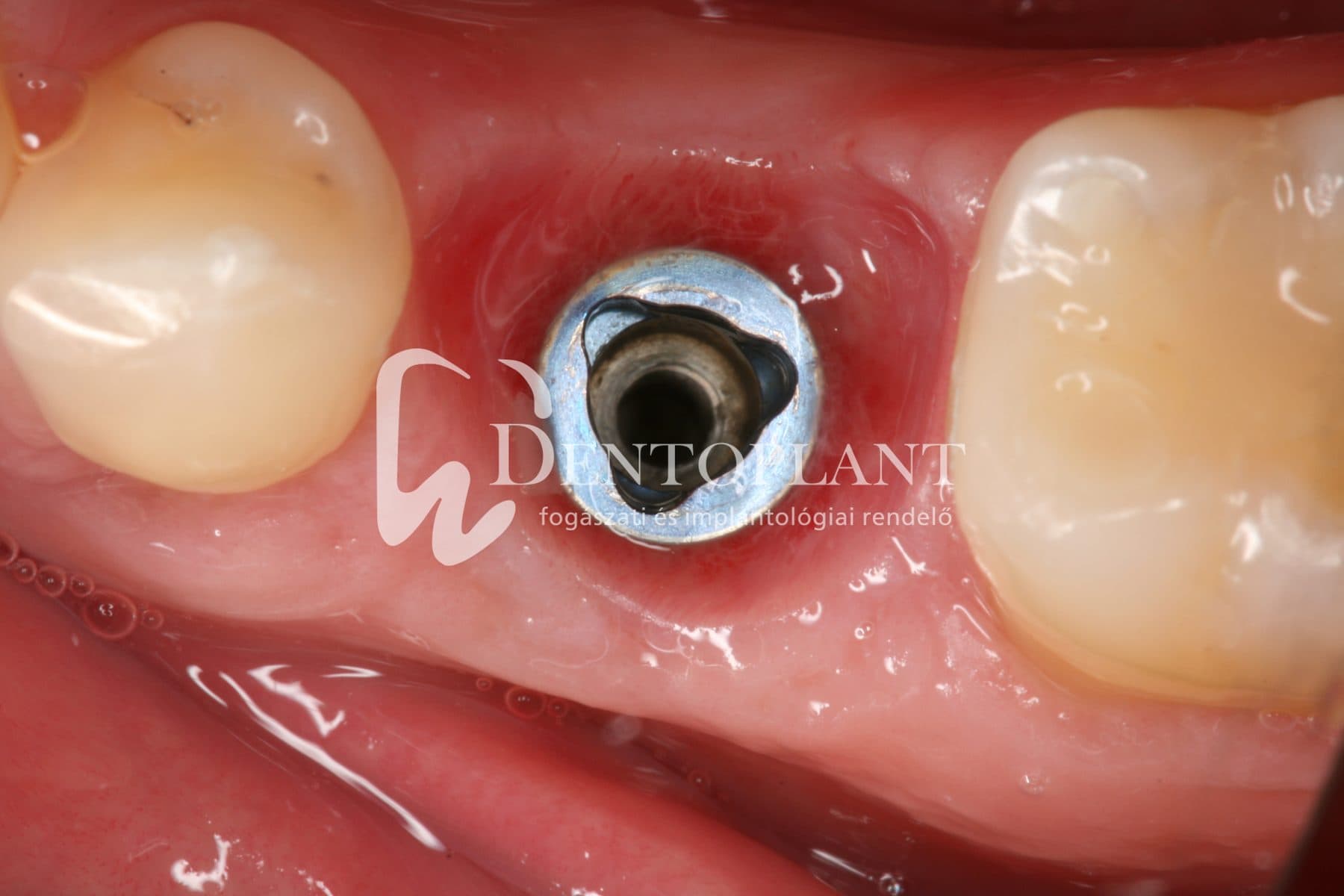 Moláris fog pótlása implantátummal – 16. kép