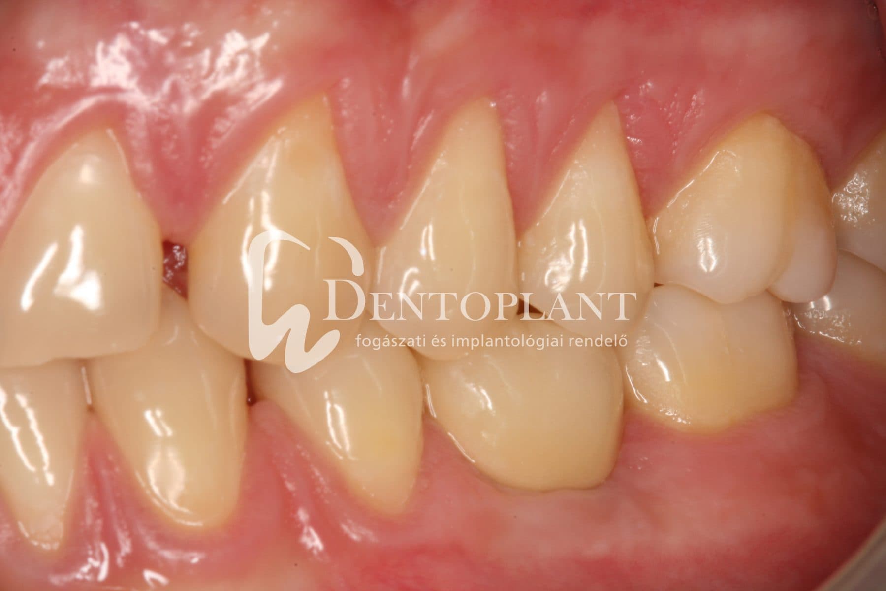Moláris fog pótlása implantátummal – 17. kép