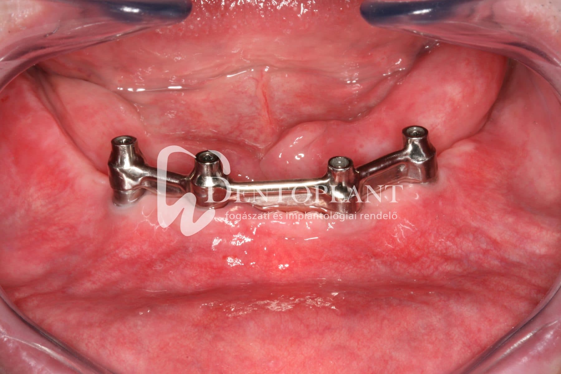 Teljes fogatlanság kezelése implantátummal – 1. kép