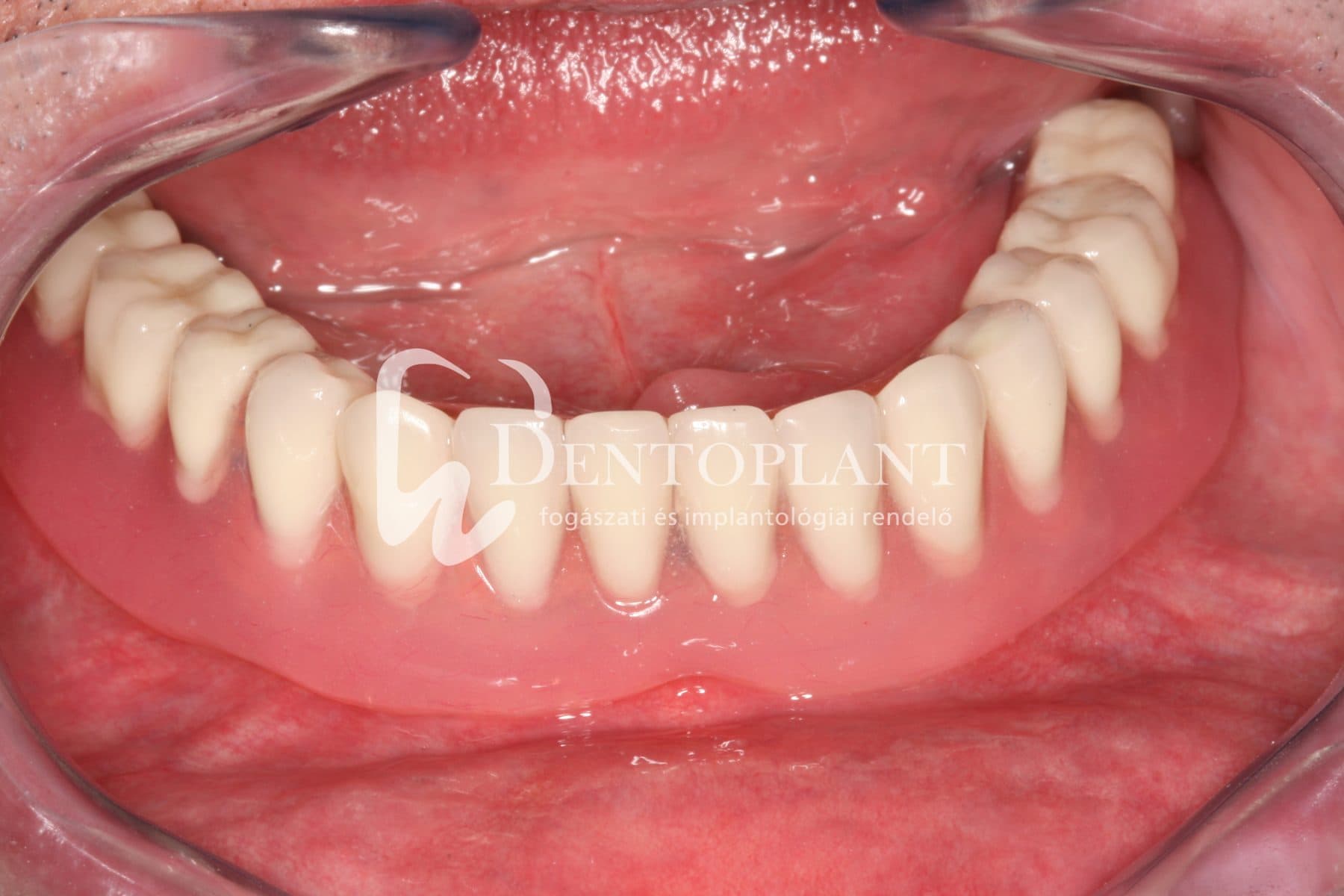 Teljes fogatlanság kezelése implantátummal – 2. kép