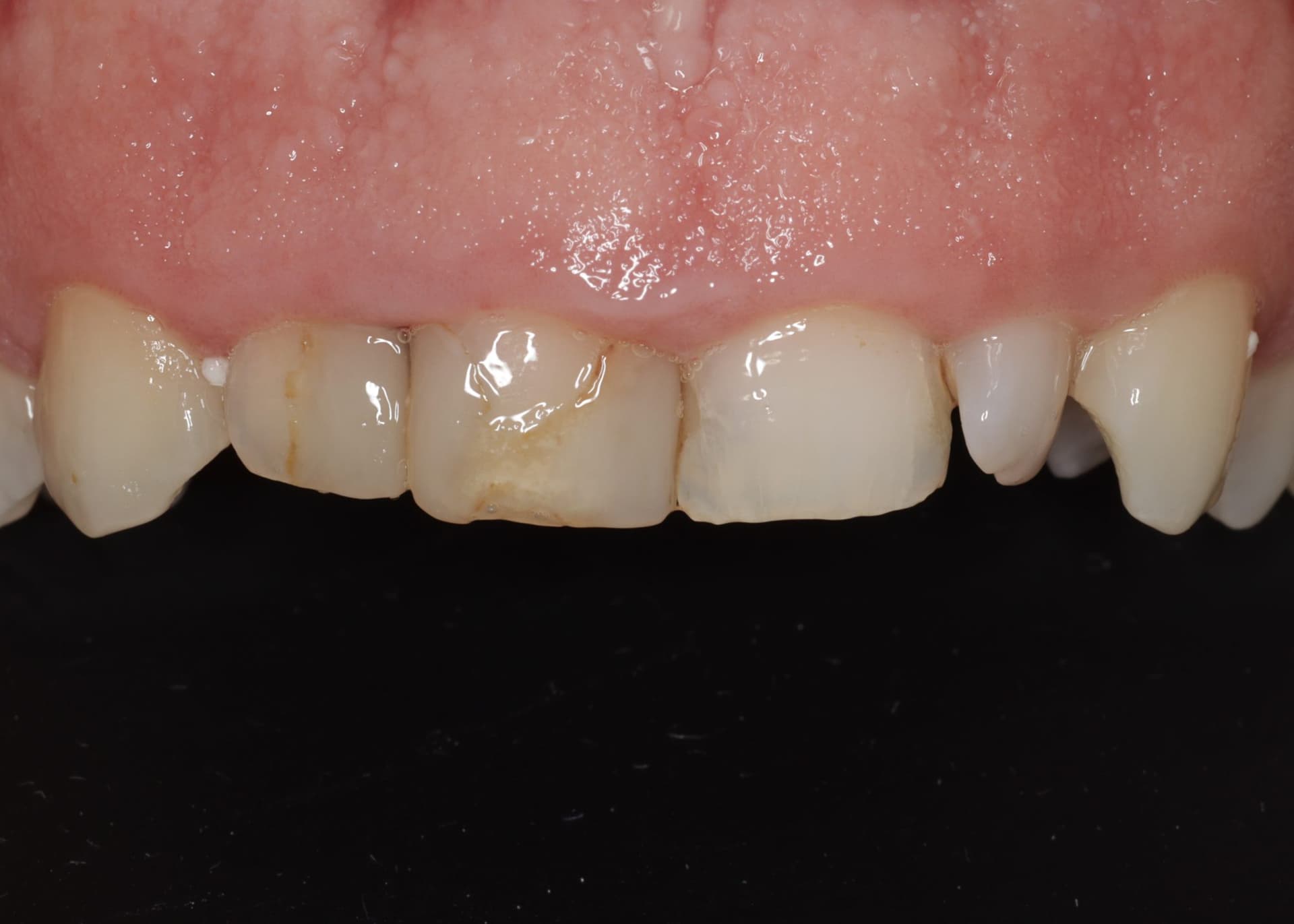 Íny mosoly korrekciója (Gum smile) — 1