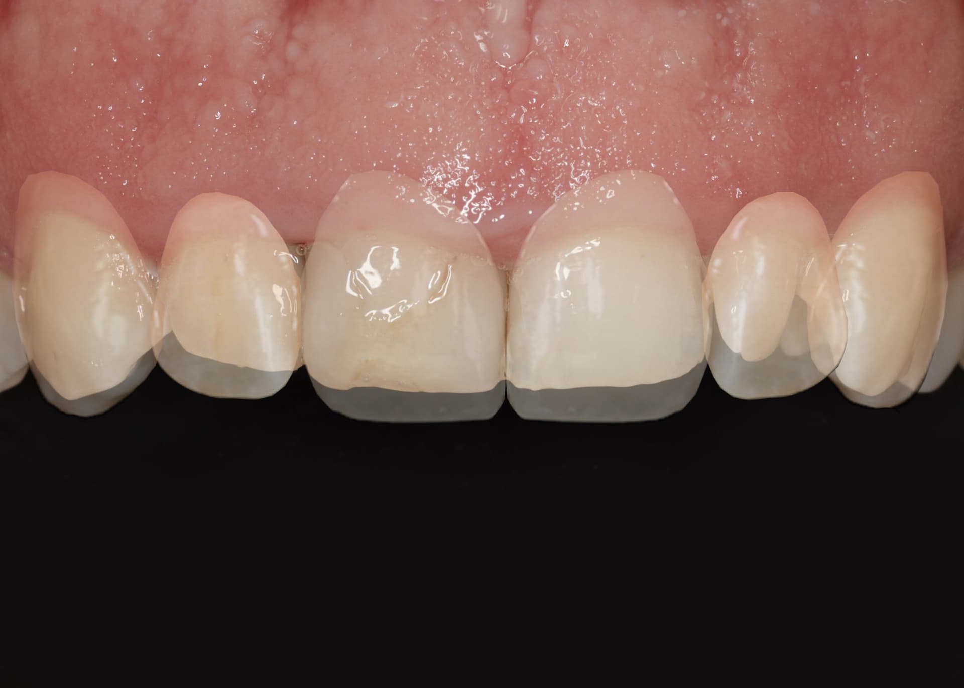 Íny mosoly korrekciója (Gum smile) — 2