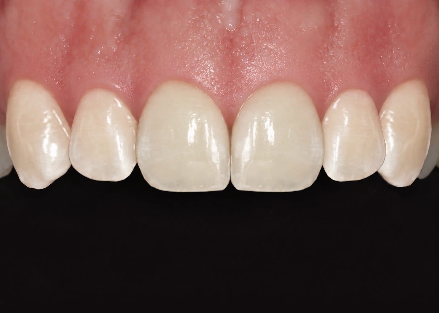 Íny mosoly korrekciója (Gum smile) — 3