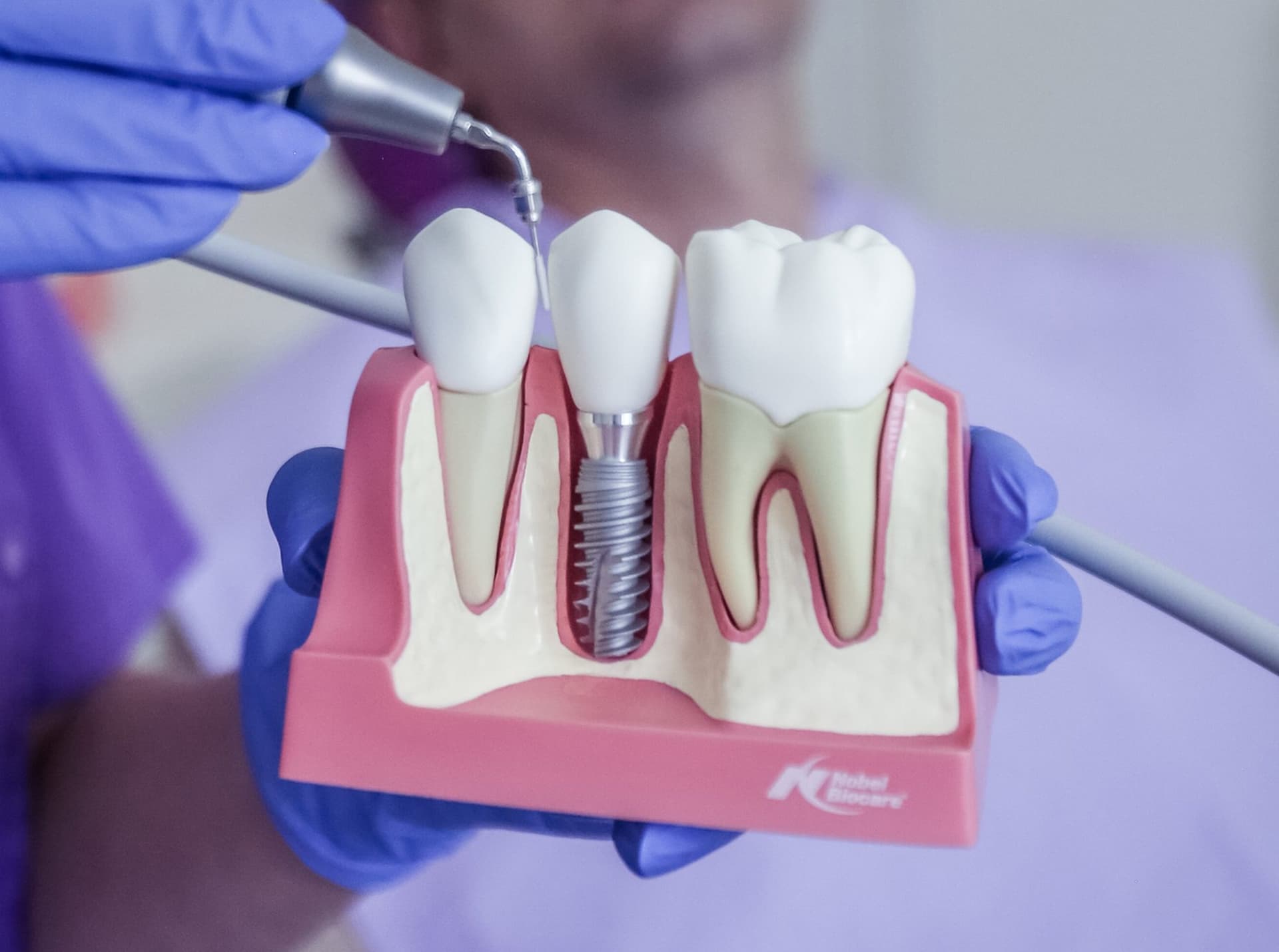 Implantátum higiéniai kezelés a Dentoplant rendelőben (5)