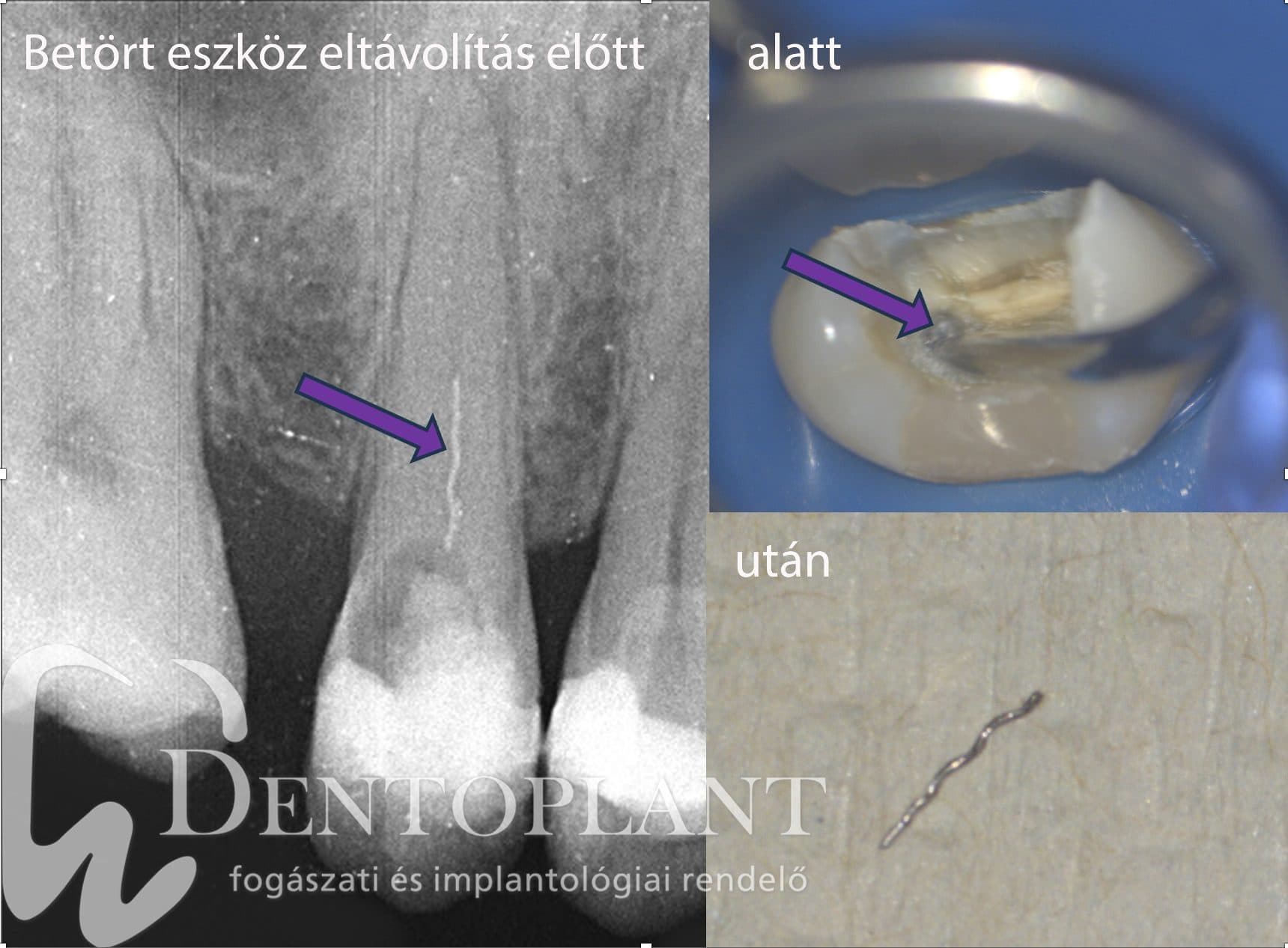 Mikroszkópos kezelés esete — betört műszer eltávolítása (1)