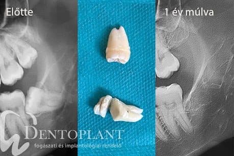 Fekvő bölcsességfog eltávolítás — előtte és utána egy képen (2)